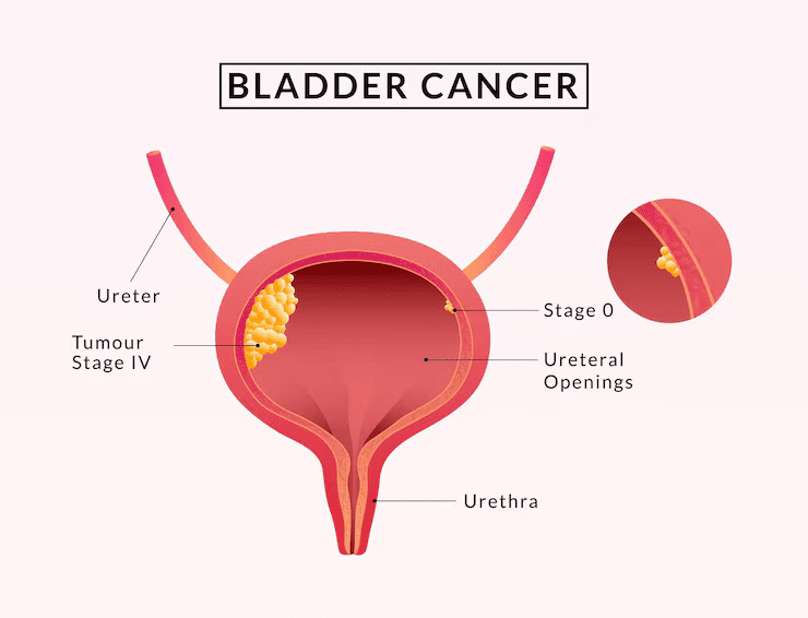 Urinary Bladder Cancer Treatment in indore