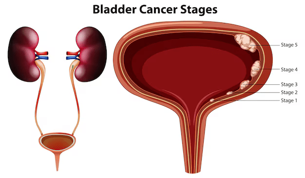 Urinary Bladder Cancer Treatment in indore