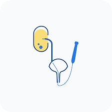 Ureterolithotripsy (URS) is a precise endoscopic procedure in indore