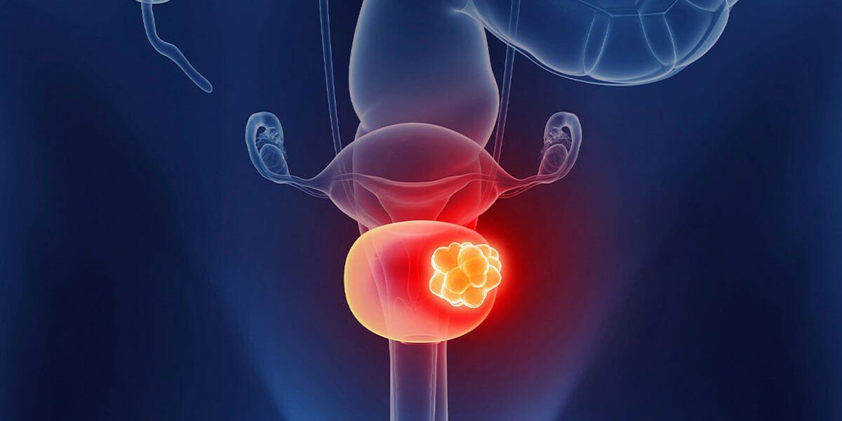 Urinary Bladder Cancer Treatment in Indore – Best Urologist and Oncologist